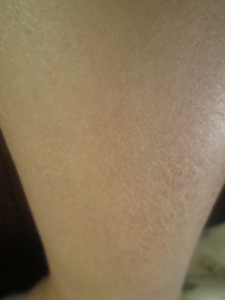 My Dry Skin Issues